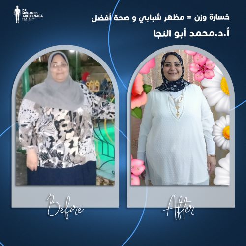 من هم المرشحون الامثل لعملية تكميم المعدة 